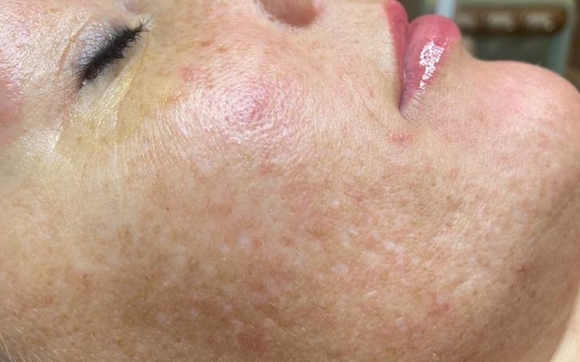 DermaCeutic Cosmo Peel rezultāts pirms procedūras